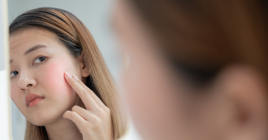 What Causes Rosacea on Face