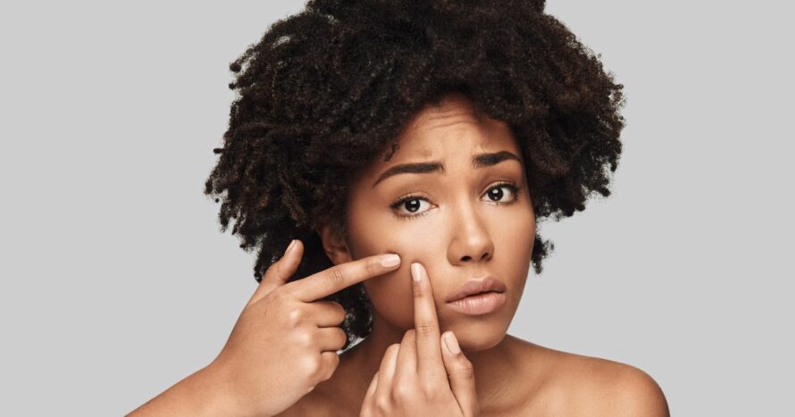 acne and polycystic ovary syndrome