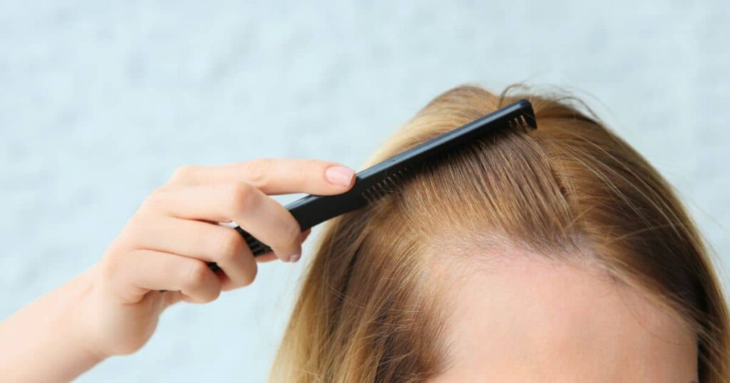 excessive hair fall women