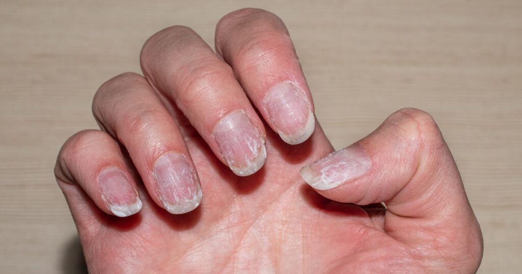 thin nails
