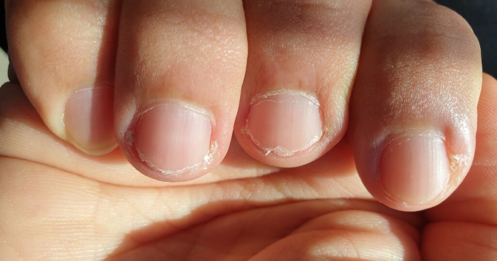 brittle nails and vitamin deficiency