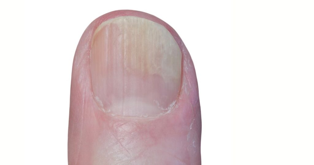vertical ridges on nails