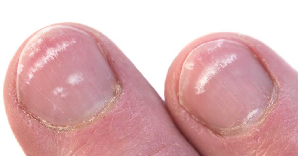 white spots on nails