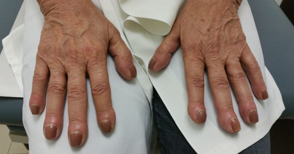 clubbing of nails