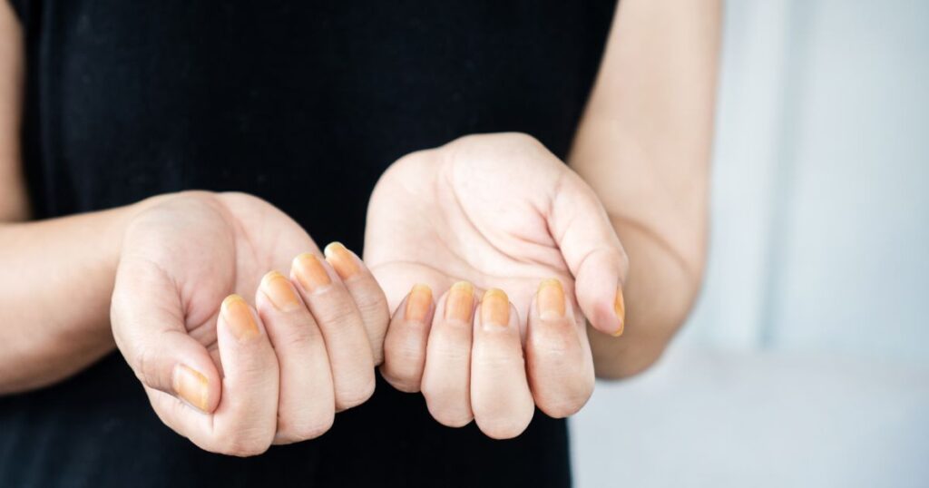 nails yellow